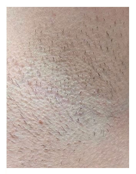 Scalp Micropigmentation Before