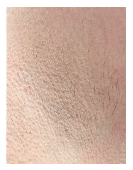 Scalp Micropigmentation After