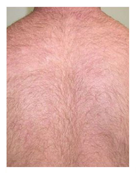Scalp Micropigmentation Before