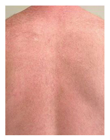 Scalp Micropigmentation After