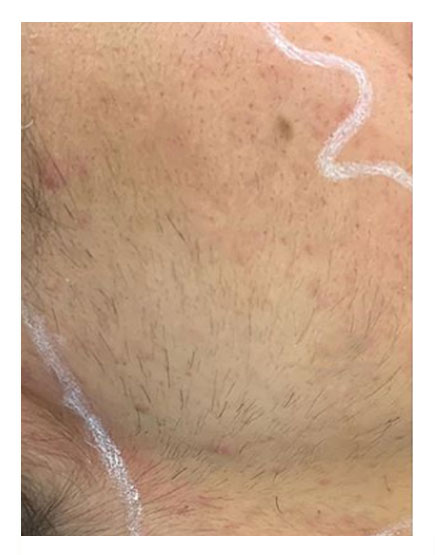 Scalp Micropigmentation Before