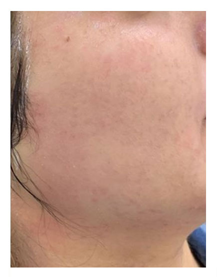 Scalp Micropigmentation After