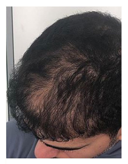 Scalp Micropigmentation Before