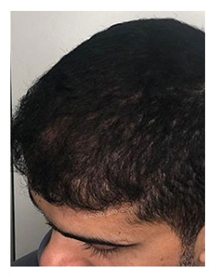 Scalp Micropigmentation After