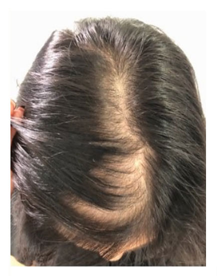 Scalp Micropigmentation Before