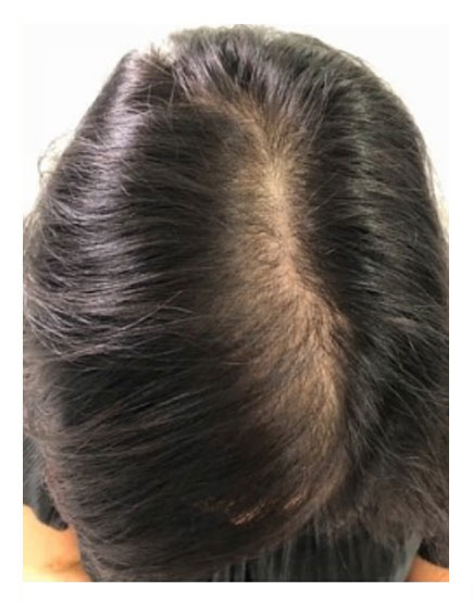 Scalp Micropigmentation After