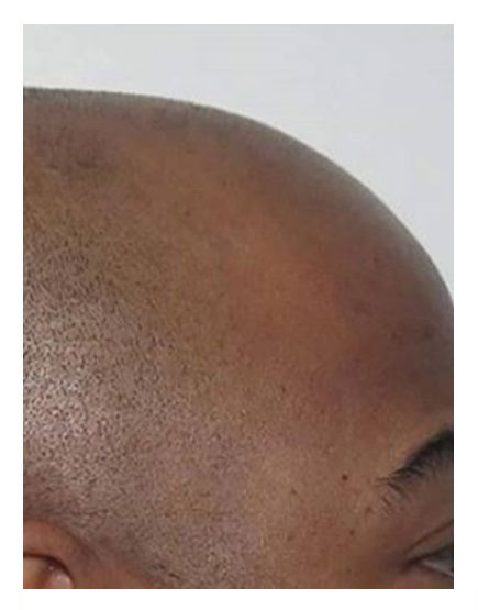 Scalp Micropigmentation Before