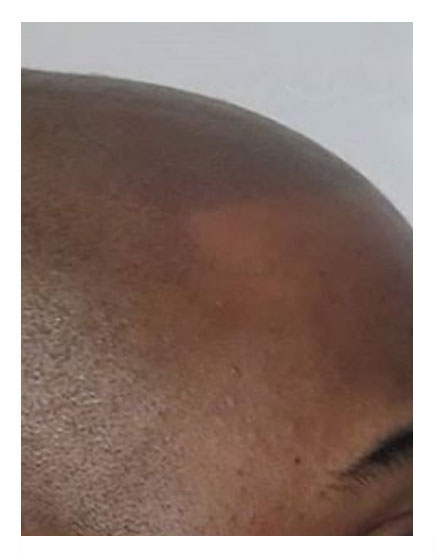 Scalp Micropigmentation After